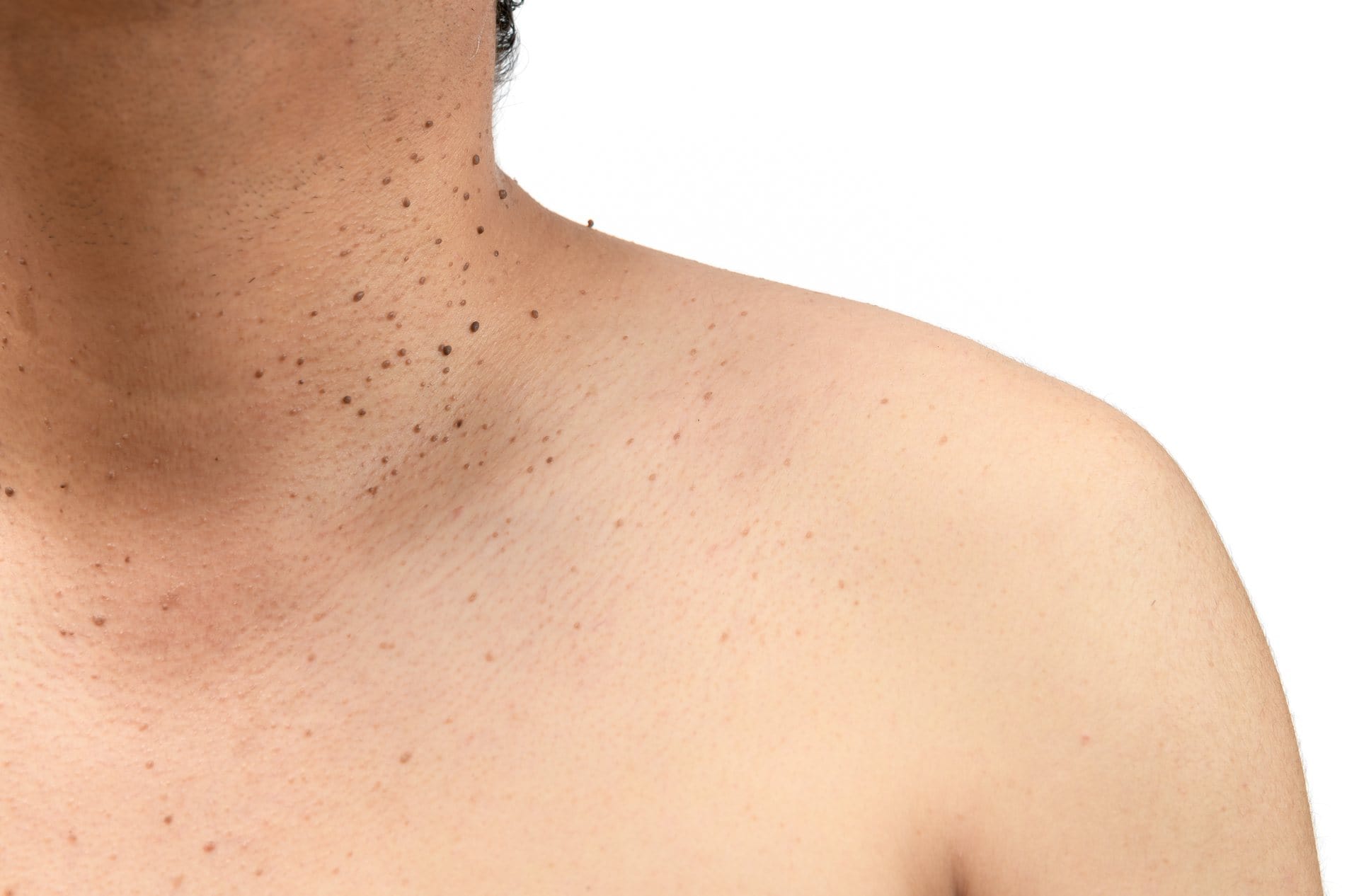 Try Radio Frequency Skin Tag Removal for ScarFree Results