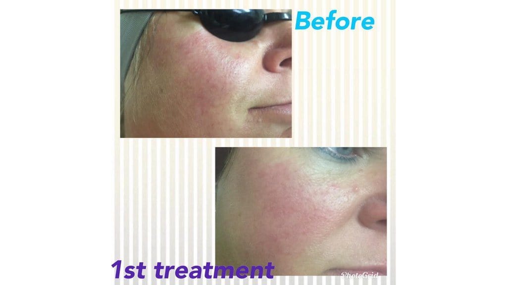 Get the Best Laser Treatment for Rosacea